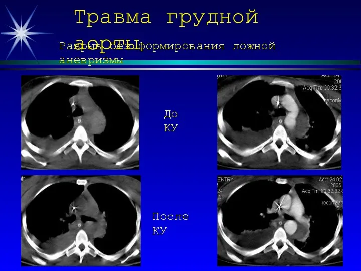 Травма грудной аорты Разрыв без формирования ложной аневризмы До КУ После КУ