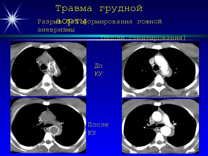 Травма грудной аорты Разрыв без формирования ложной аневризмы (после стентирования) До КУ После КУ