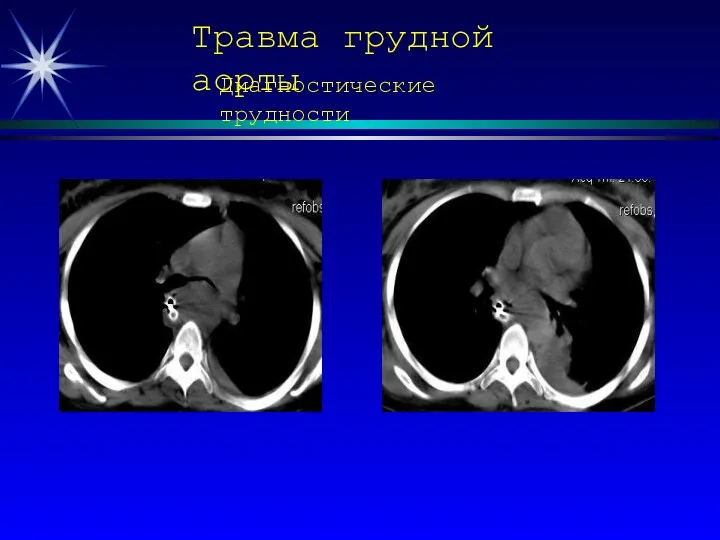 Травма грудной аорты Диагностические трудности