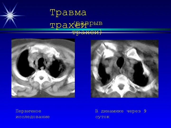 Травма трахеи (разрыв трахеи) Первичное исследование В динамике через 9 суток