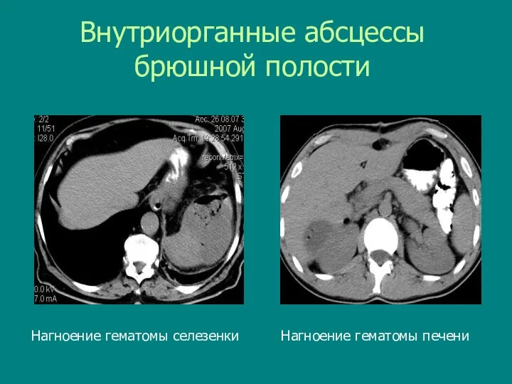 Внутриорганные абсцессы брюшной полости Нагноение гематомы печени Нагноение гематомы селезенки