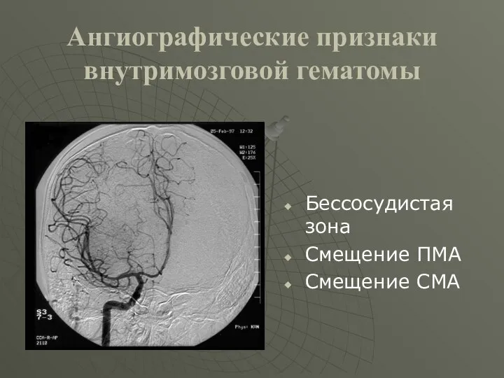 Ангиографические признаки внутримозговой гематомы Бессосудистая зона Смещение ПМА Смещение СМА