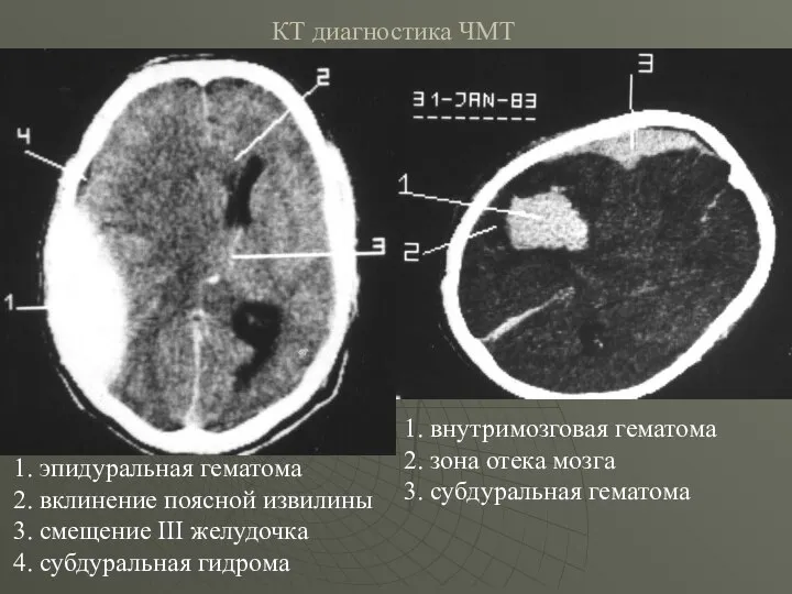 КТ диагностика ЧМТ 1. эпидуральная гематома 2. вклинение поясной извилины 3.