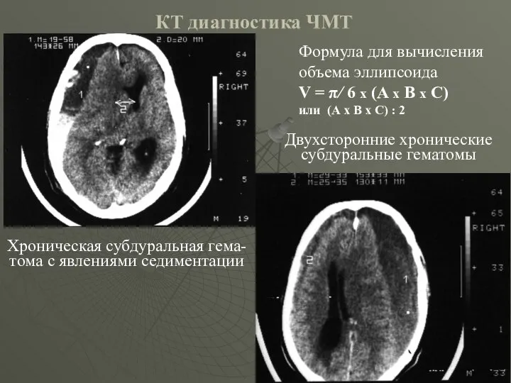 КТ диагностика ЧМТ Хроническая субдуральная гема- тома с явлениями седиментации Двухсторонние