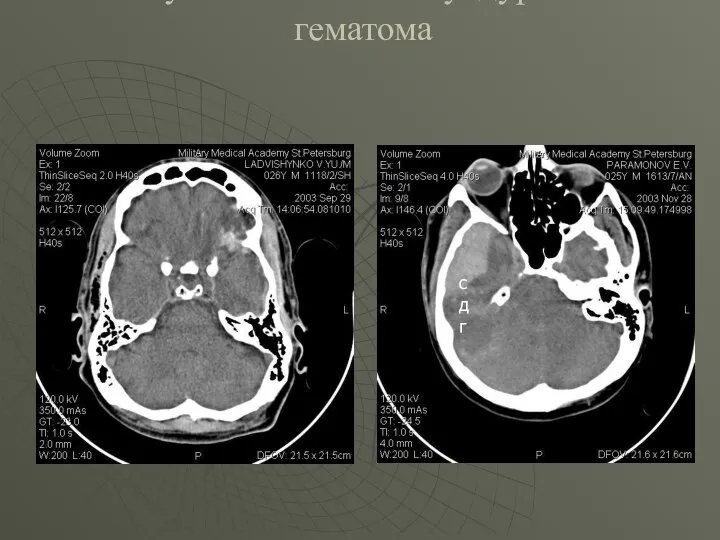 Контузионный очаг и субдуральная гематома сдг