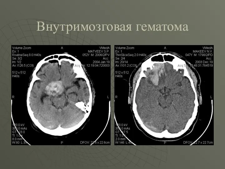 Внутримозговая гематома