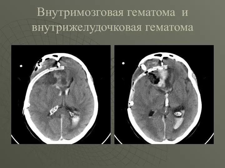 Внутримозговая гематома и внутрижелудочковая гематома