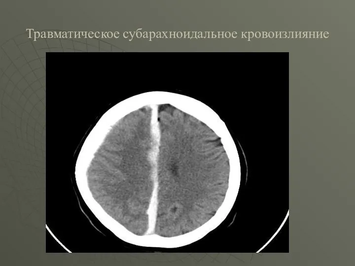 Травматическое субарахноидальное кровоизлияние