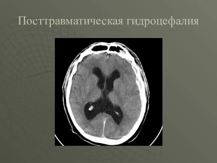 Посттравматическая гидроцефалия