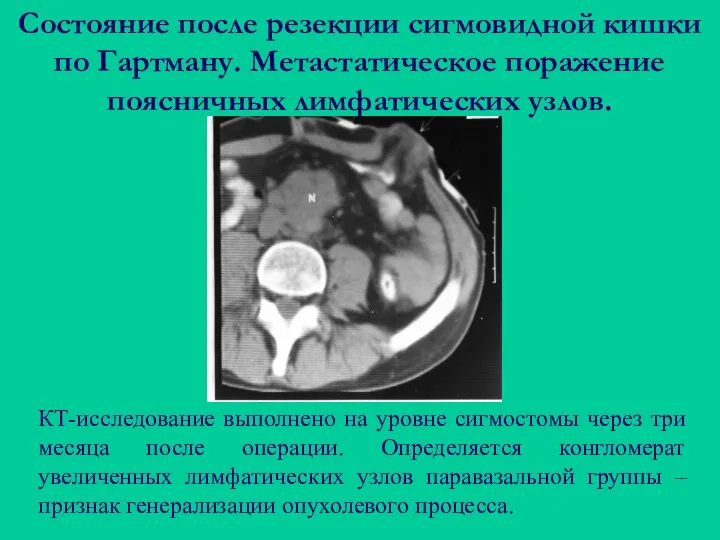 Состояние после резекции сигмовидной кишки по Гартману. Метастатическое поражение поясничных лимфатических