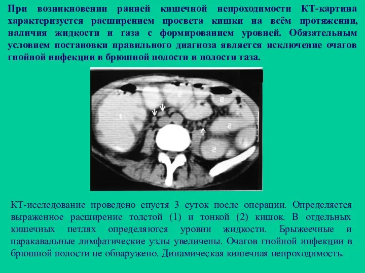 При возникновении ранней кишечной непроходимости КТ-картина характеризуется расширением просвета кишки на