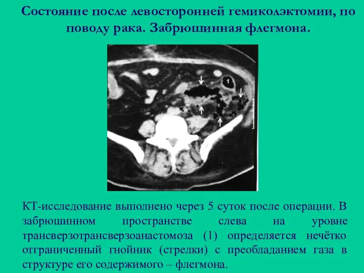 Состояние после левосторонней гемиколэктомии, по поводу рака. Забрюшинная флегмона. КТ-исследование выполнено