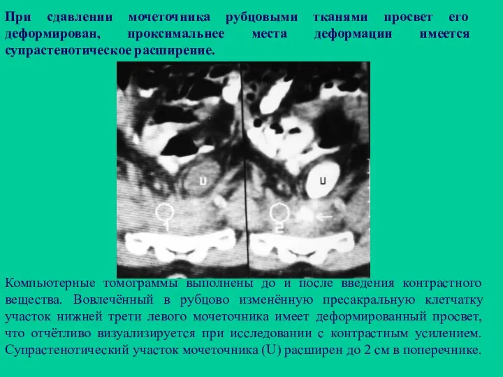 При сдавлении мочеточника рубцовыми тканями просвет его деформирован, проксимальнее места деформации