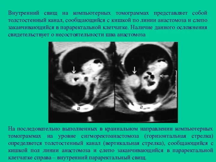 Внутренний свищ на компьютерных томограммах представляет собой толстостенный канал, сообщающийся с