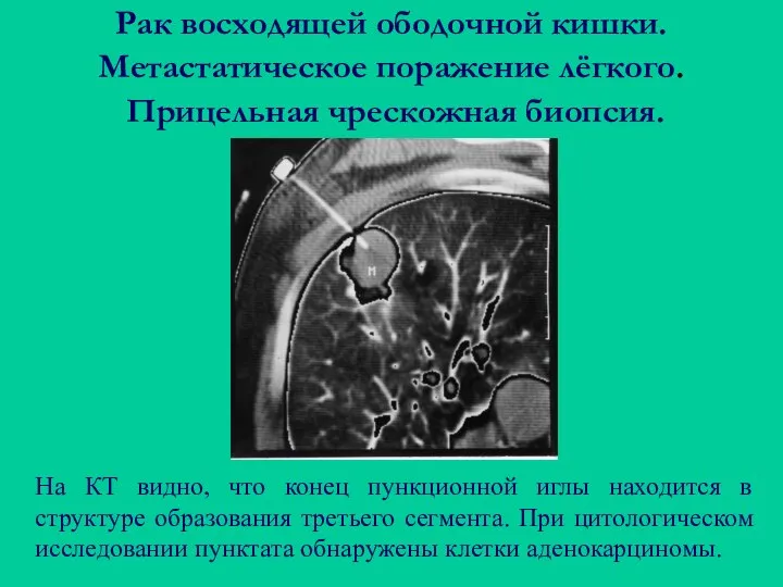 Рак восходящей ободочной кишки. Метастатическое поражение лёгкого. Прицельная чрескожная биопсия. На