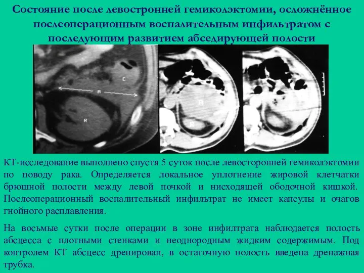 Состояние после левостронней гемиколэктомии, осложнённое послеоперационным воспалительным инфильтратом с последующим развитием