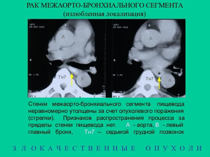 РАК МЕЖАОРТО-БРОНХИАЛЬНОГО СЕГМЕНТА (излюбленная локализация) З Л О К А Ч