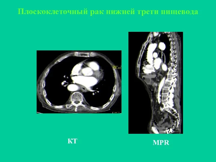 КТ Плоскоклеточный рак нижней трети пищевода MPR