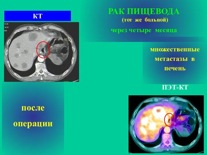 РАК ПИЩЕВОДА (тот же больной) через четыре месяца после операции ПЭТ-КТ КТ множественные метастазы в печень