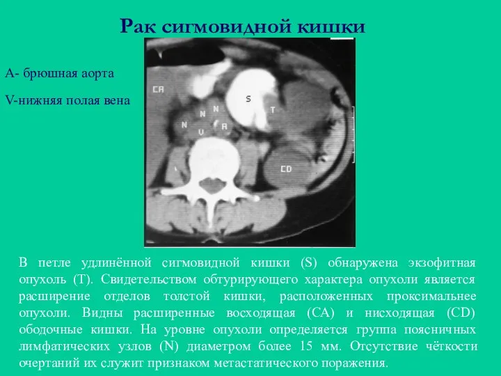 Рак сигмовидной кишки В петле удлинённой сигмовидной кишки (S) обнаружена экзофитная