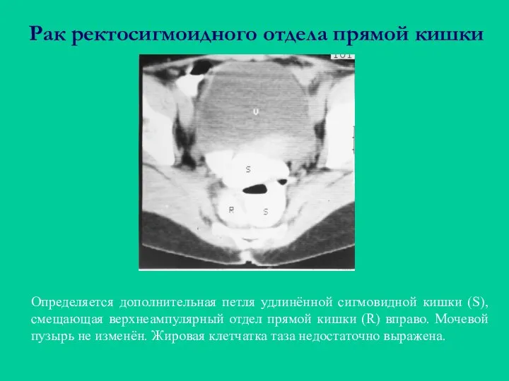 Рак ректосигмоидного отдела прямой кишки Определяется дополнительная петля удлинённой сигмовидной кишки