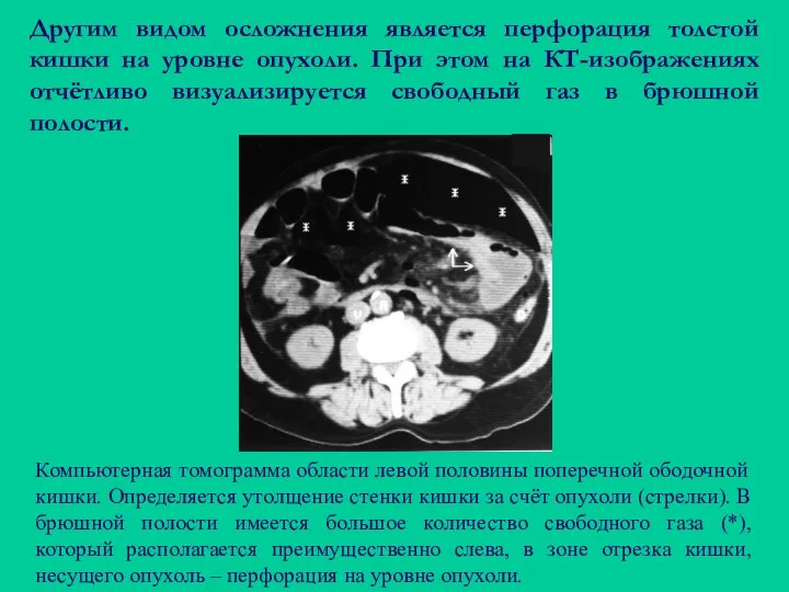 Другим видом осложнения является перфорация толстой кишки на уровне опухоли. При