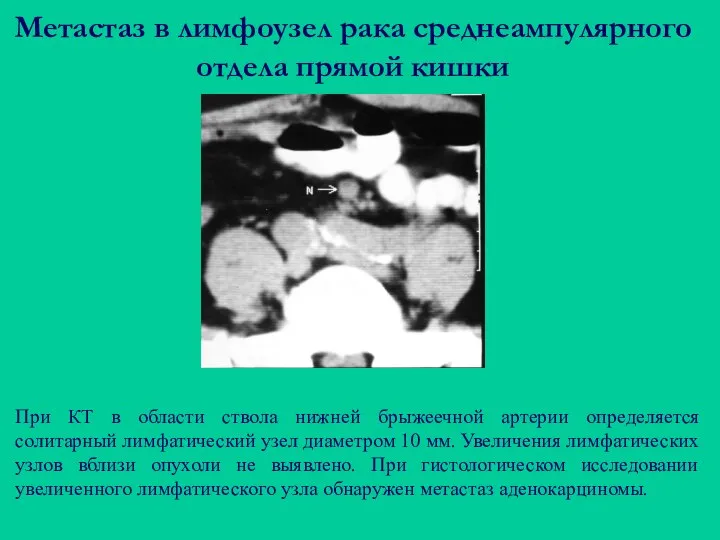 Метастаз в лимфоузел рака среднеампулярного отдела прямой кишки При КТ в