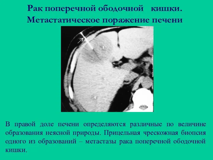 Рак поперечной ободочной кишки. Метастатическое поражение печени В правой доле печени