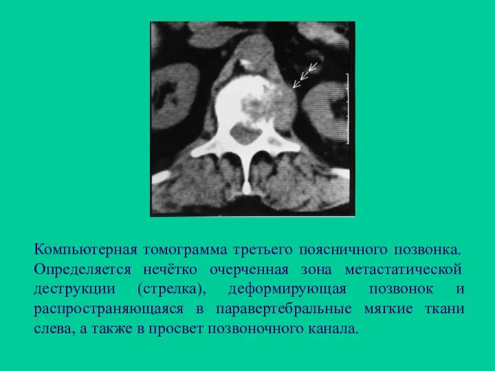 Компьютерная томограмма третьего поясничного позвонка. Определяется нечётко очерченная зона метастатической деструкции