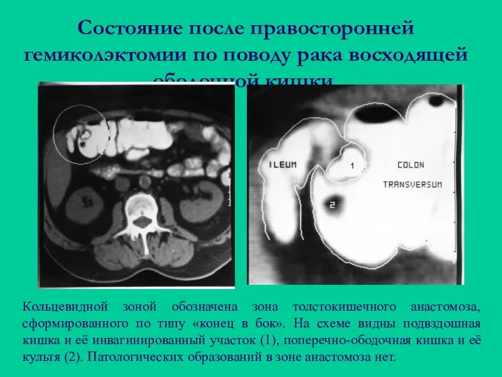 Состояние после правосторонней гемиколэктомии по поводу рака восходящей ободочной кишки. Кольцевидной