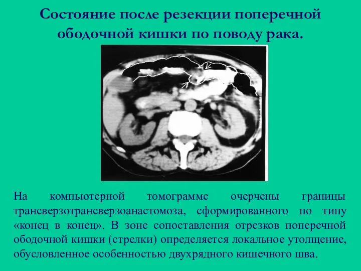 Состояние после резекции поперечной ободочной кишки по поводу рака. На компьютерной