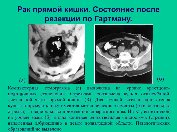 Рак прямой кишки. Состояние после резекции по Гартману. Компьютерная томограмма (а)