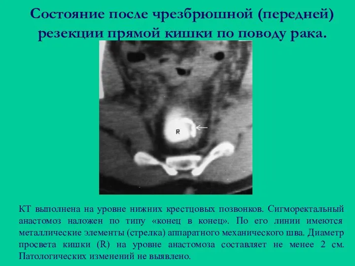 Состояние после чрезбрюшной (передней) резекции прямой кишки по поводу рака. КТ