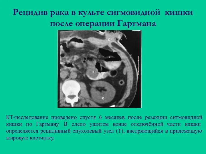 Рецидив рака в культе сигмовидной кишки после операции Гартмана КТ-исследование проведено