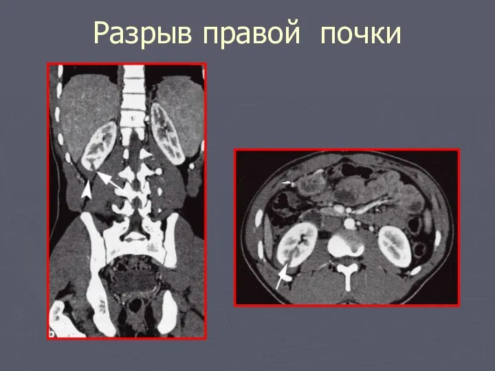 Разрыв правой почки