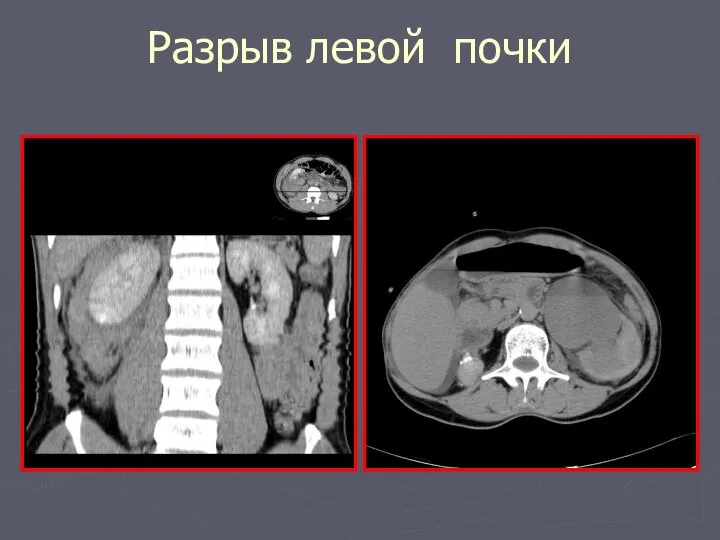 Разрыв левой почки