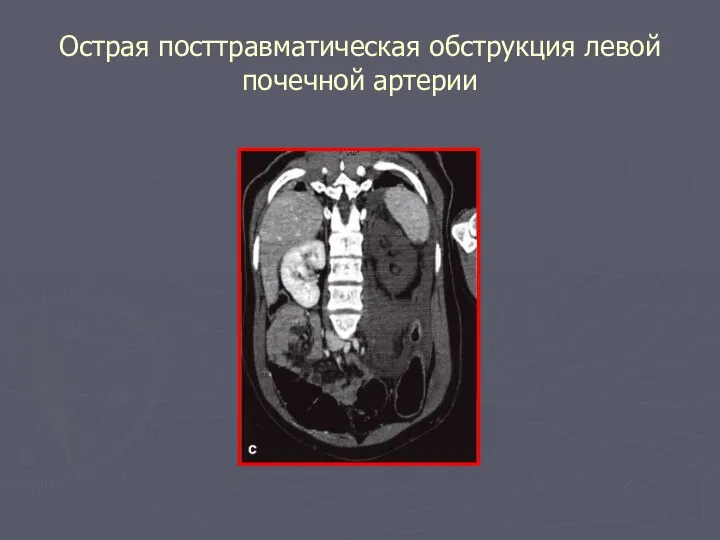 Острая посттравматическая обструкция левой почечной артерии