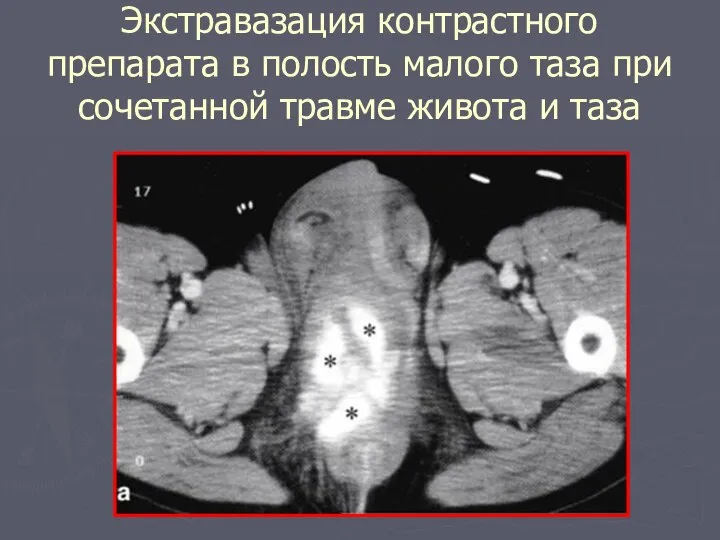 Экстравазация контрастного препарата в полость малого таза при сочетанной травме живота и таза