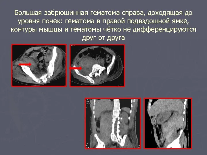 Большая забрюшинная гематома справа, доходящая до уровня почек: гематома в правой