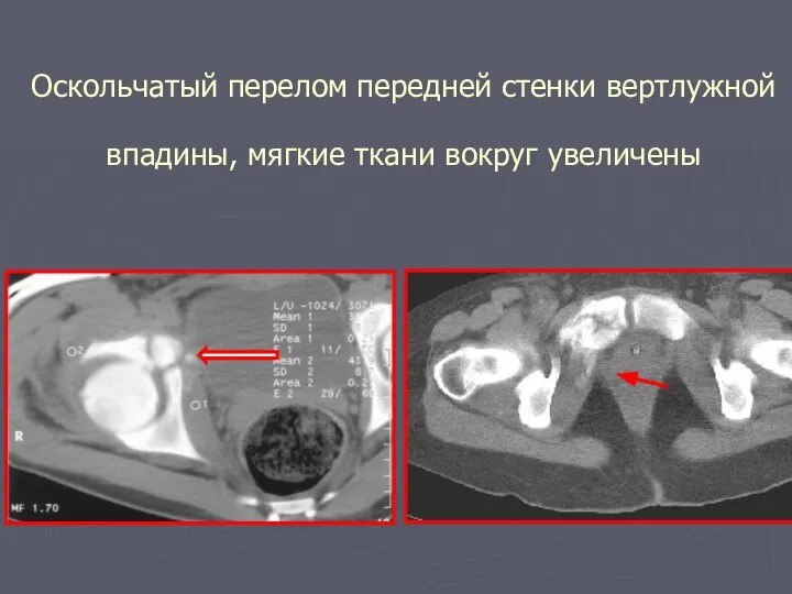 Оскольчатый перелом передней стенки вертлужной впадины, мягкие ткани вокруг увеличены