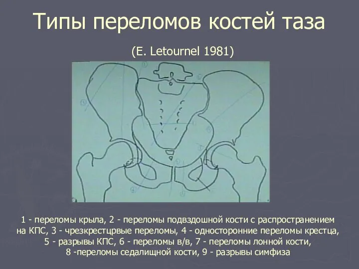 Типы переломов костей таза (E. Letournel 1981) 1 - переломы крыла,