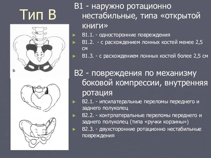 Тип В В1 - наружно ротационно нестабильные, типа «открытой книги» В1.1.