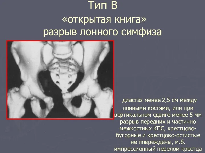 Тип В «открытая книга» разрыв лонного симфиза диастаз менее 2,5 см