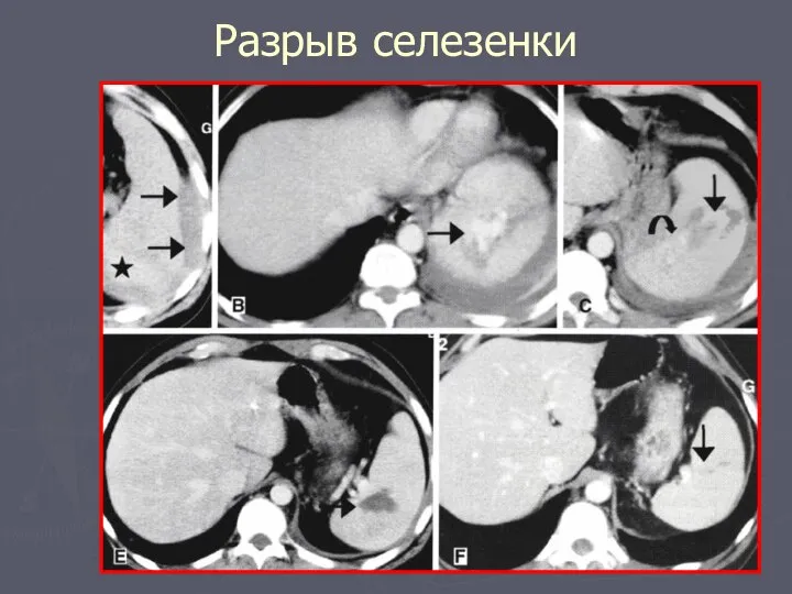 Разрыв селезенки