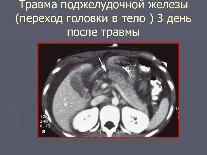 Травма поджелудочной железы(переход головки в тело ) 3 день после травмы