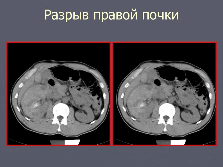 Разрыв правой почки