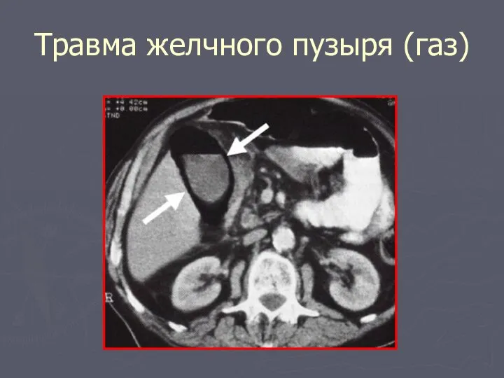 Травма желчного пузыря (газ)