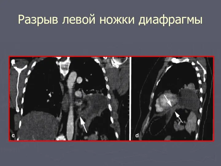 Разрыв левой ножки диафрагмы