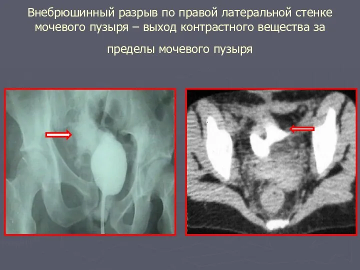 Внебрюшинный разрыв по правой латеральной стенке мочевого пузыря – выход контрастного вещества за пределы мочевого пузыря