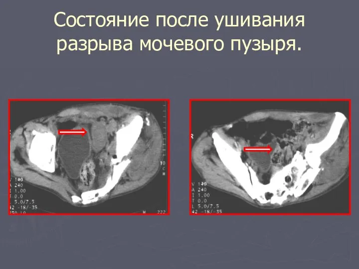 Состояние после ушивания разрыва мочевого пузыря.